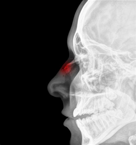 Learn about deviated septum surgery (septoplasty) and turbinectomy (nasal airway surgery procedures) to improve breathing deviated septum surgery (septoplasty) is surgery to correct a deformity in the nasal septum. Fixing a Broken Nose: Don't Try This at Home - Zwivel