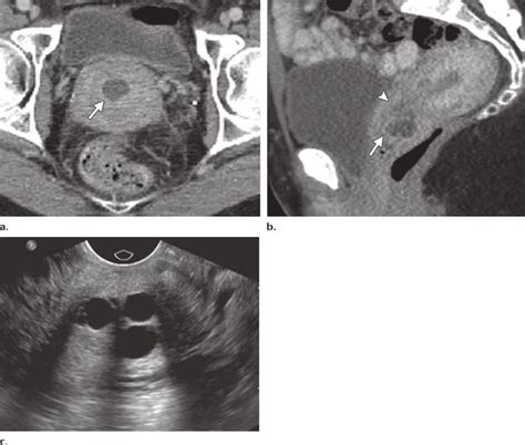 Nabothian Cyst In Cervix Ultrasound