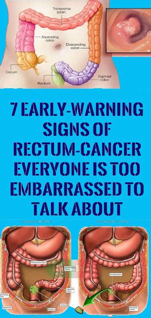 Dont Ignore These 6 Signs That May Indicate Anal Cancer Healthy