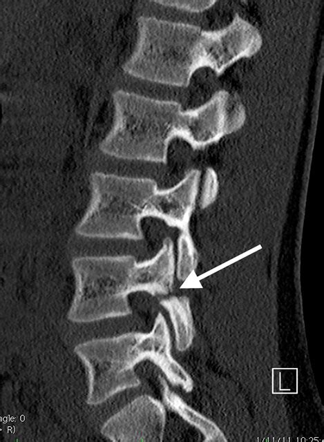 What Is A Pars Fracture Defect The Trauma Pro