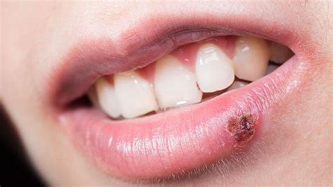 What Is A Cold Sore Dental Blog