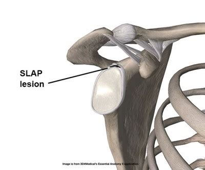 Research Review Conservative Treatment Of A Slap Lesion Academy Of