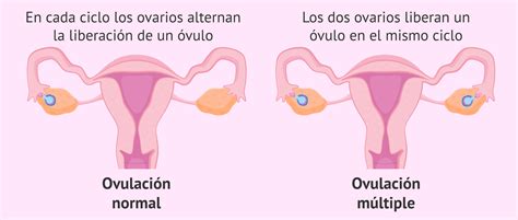 Qué es la ovulación múltiple y cuáles son sus causas