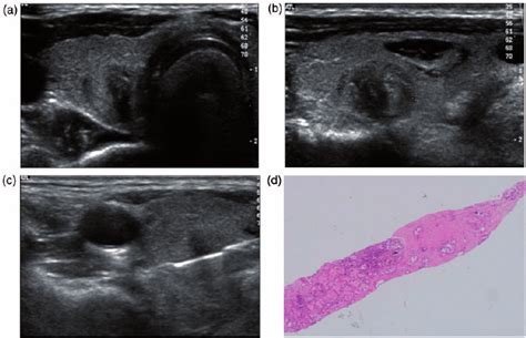 Needle biopsies are usually done on an outpatient basis. Core needle biopsy (CNB) procedure. (a, b) Transverse and ...
