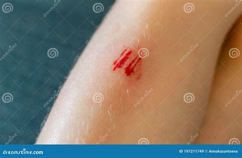 Fresh Scratch With Blood On A Child`s Leg Close Up Stock Image Image