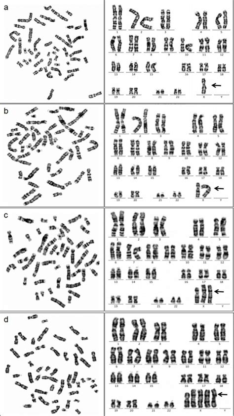 A Rare Of Turner Syndrome With A Special Karyotype A Case Report