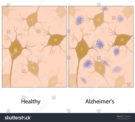 Alzheimer S Disease Brain Tissue With Amyloid Plaque Stock Vector Illustration 114998068