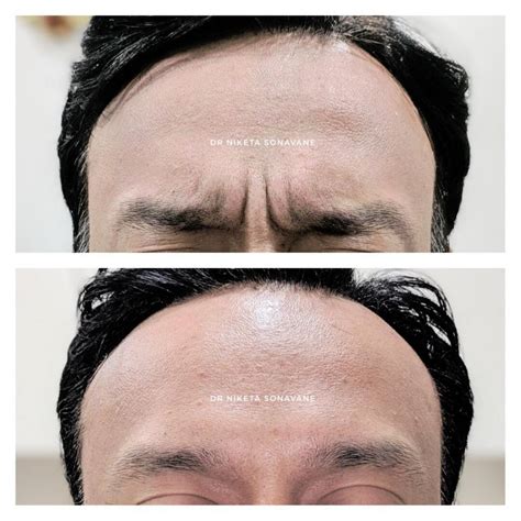 Botox Treatment In Mumbai Cost Natural Results Before After
