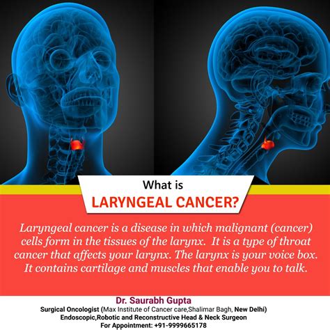 Dr Saurabh Gupta Oncologist What Is Laryngeal Cancer