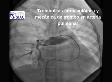 Embolia Pulmonar