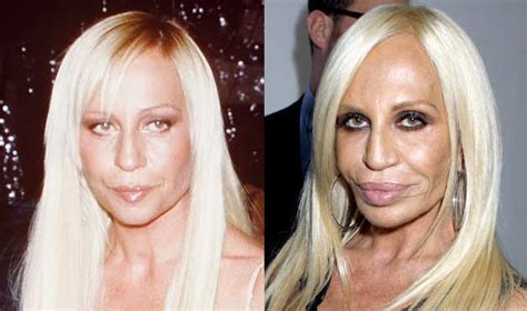 8 Celebrity Plastic Surgery Gone Bad Really Bad News Stories