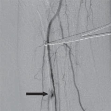 Post Angioplasty Angiogram Of The Leg Shows Extravasation Of Contrast
