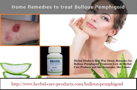 11 Herbal Treatment For Bullous Pemphigoid Herbal Care Products Blog