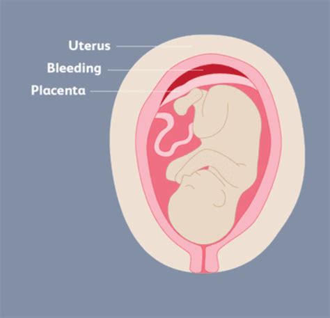 Bleeding In Early Pregnancy The Obgyn Mum