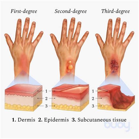 The Types Of Burns First Degree Second Degree Third Degree Daily Infographic