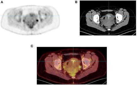 Frontiers F 18 Fdg Petct Imaging In Normal Variants Pitfalls And