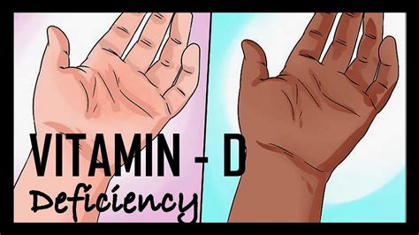 6 Reasons Prove That You May Be Vitamin D Deficient Youtube