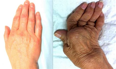 Guía para Pacientes del Manejo Clínico de la Artritis Reumatoide