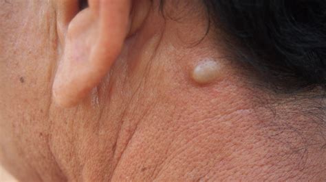 What S A Sebaceous Cyst Signs Treatments And What To Expect Md Nutrition