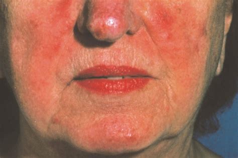 The Best Skin Care Routine For Rosacea Readers Digest
