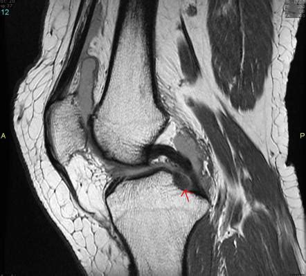 Root Tear Of Medial Meniscus Radiology Case Radiopaedia Org Sexiz Pix