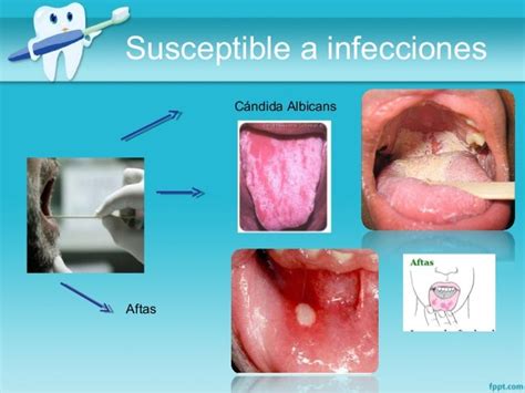 Manifestaciones Orales En Enfermedades Endocrinas Diabetes