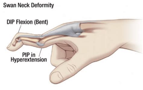 Swan Neck Deformity Teton Hand Surgery