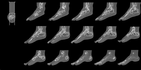 Foot And Ankle Ct Scan Omega Pds