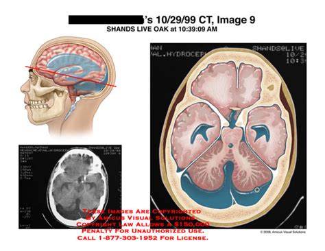 AMICUS Illustration Of Amicus Radiology CT Brain Fluid Cerebellum Axial