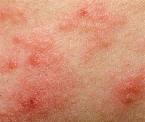 Dermatite Alergica