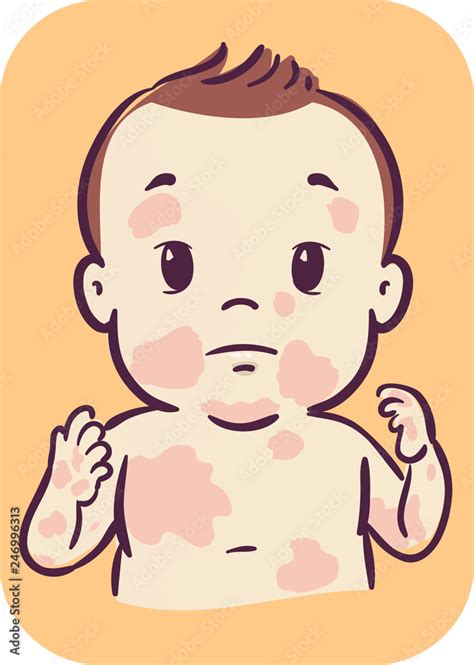 Baby Skin Rashes Illustration Stock Vector Adobe Stock