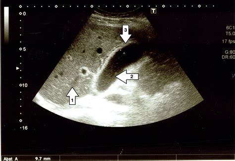 Acute Cholecystitis As Related To Cholecystectomy Pictures