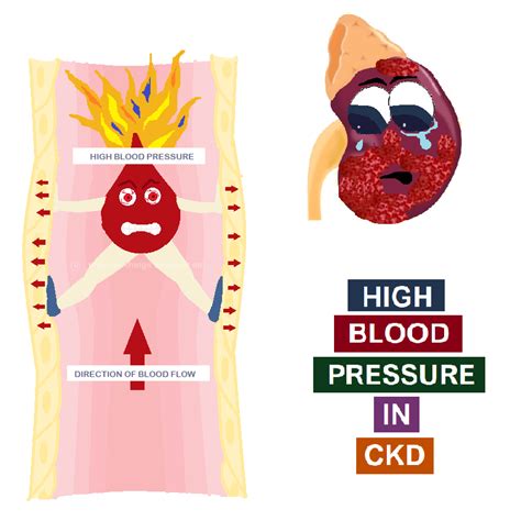 High Blood Pressure In Ckd All Things Kidney ~ Official