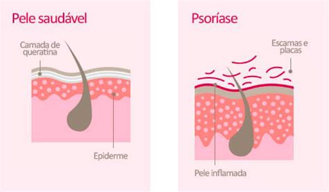 O Que é Psoríase Dermatologista Porto Alegre Dra Juliana Fonte