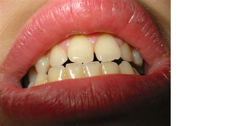 Teeth Grinding Causes Effects And Management Top Notch Dental