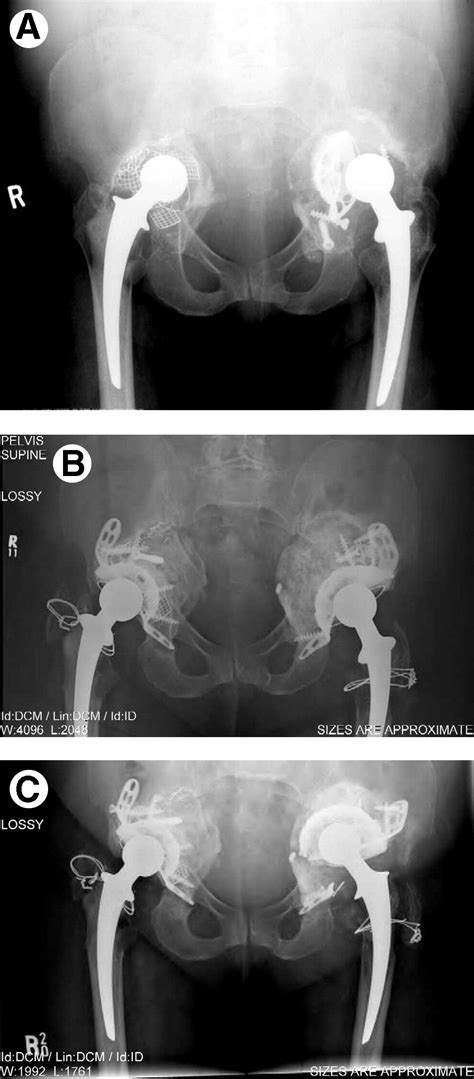 Massive Acetabular Bone Loss The Cup Cage Solution Seminars In