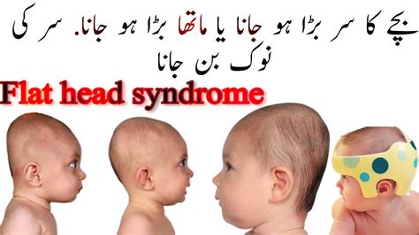 Baby Head Shape Correction Flat Head Syndrome Bachon Ke Sir Ko