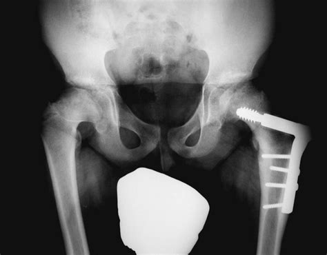 Enfermedad De Perthes Osteotomia Cadera Izquierda Secuelas Flickr