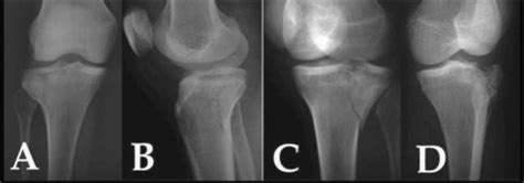 Radiographic Projections For Diagnosis Of Tibial Plateau Fractures A