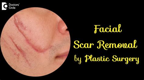 Vanish Facial Scars Facial Scar Removal By Plastic Surgery Dr