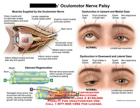Congenital right third cranial nerve palsy with exotropia, intact pupillary and accommodation responses, minimal ptosis, and diminished elevation 15. Oculomotor Nerve Palsy