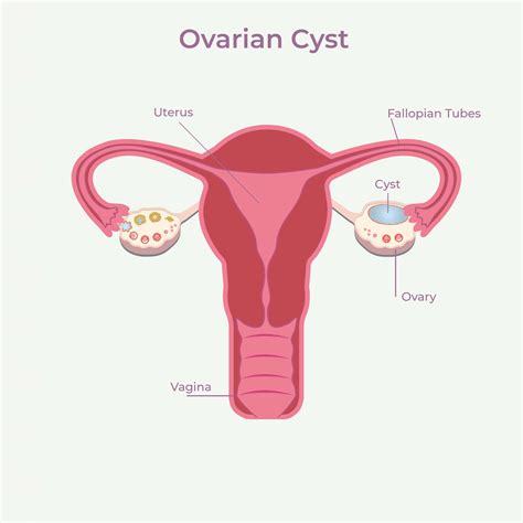 Understanding Ovarian Cysts Symptoms Types And Treatment Coach M
