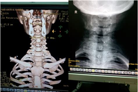 Figure 3 Ct And X Ray Of Patient No 4 Showing Left Sided Cervical Ribs