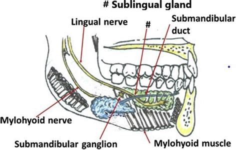 Excision Of Sublingual Gland Pocket Dentistry