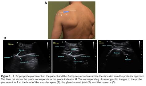 Msk Ultrasound For Shoulder Dislocation Journalfeed