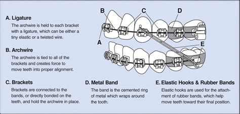 How Do Braces Move Teeth Zaki Orthodontics Va Beach