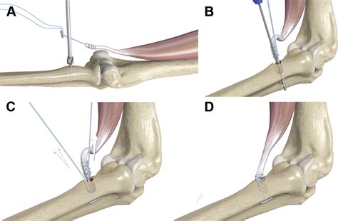 Surgical Treatment Of Distal Biceps Ruptures Orthopedic Clinics