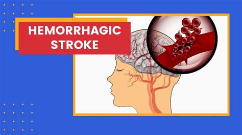 Hemorrhagic Stroke Youtube