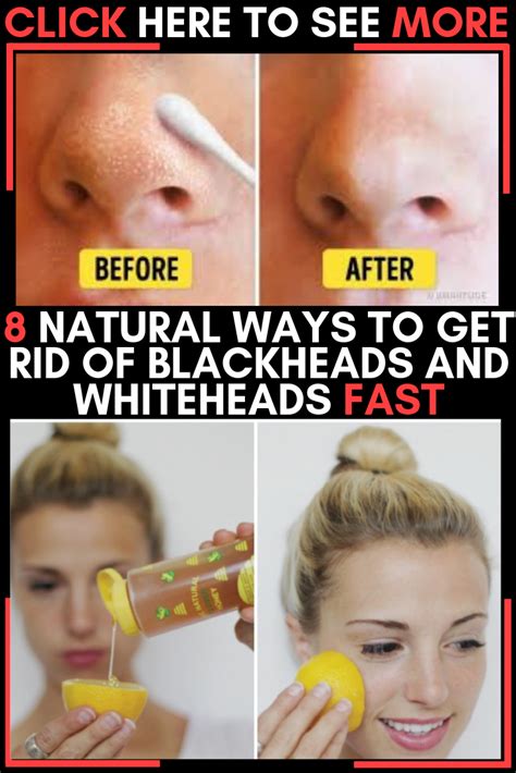 How To Naturally Get Rid Of Blackheads And Whiteheads Howtoermov