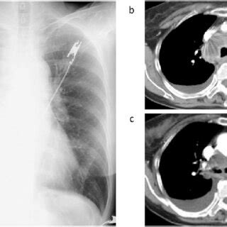 Chest X Ray And Computed Tomography CT After Stent Placement And Two